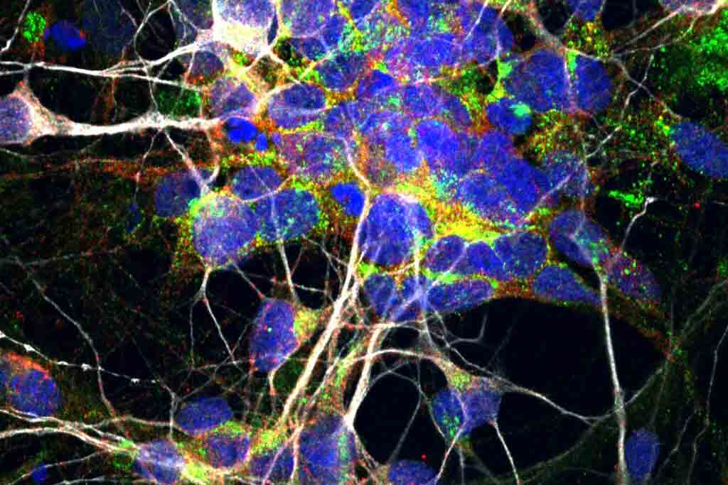 Why nerve cells die in ALS and some dementia cases - USC Today